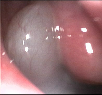 Nasenpolyp