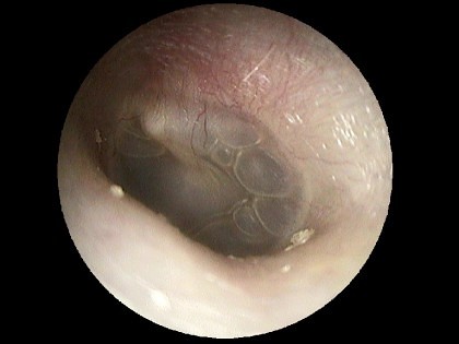Luftblasen bei Flüssigkeit im Mittelohr