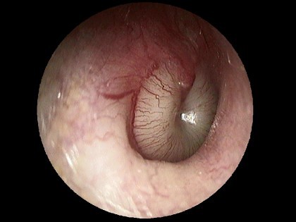 Mittelohrentzündung mit Eiter im Mittelohr