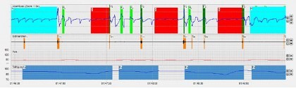 Schlafapnoe-Risikotest