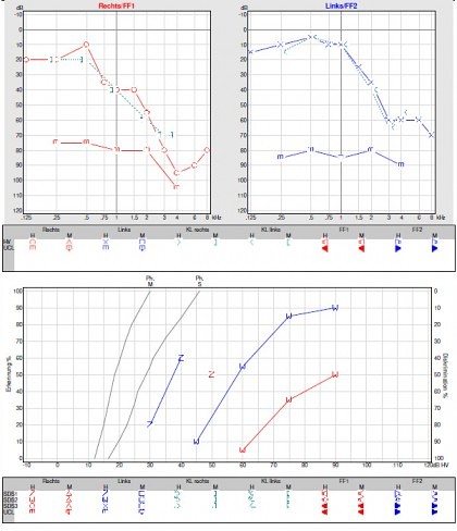 Reintonaudiogramm und Sprachhoertest bei hochtonbetonte Innenohrschwerhörigkeit