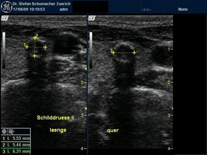 Schilddrüsenknoten verkalkt