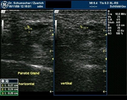 Sonographisches Bild eines Steines im Ausführgang der Ohrspeicheldrüse